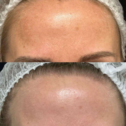Фотоомоложение на аппарате Estetica 3.0